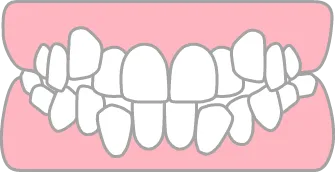 叢生（乱ぐい歯）