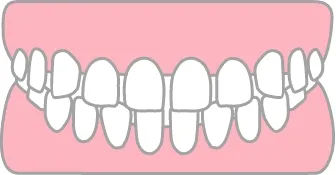 空隙歯列（すきっ歯）