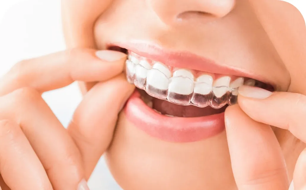 インビザラインGo