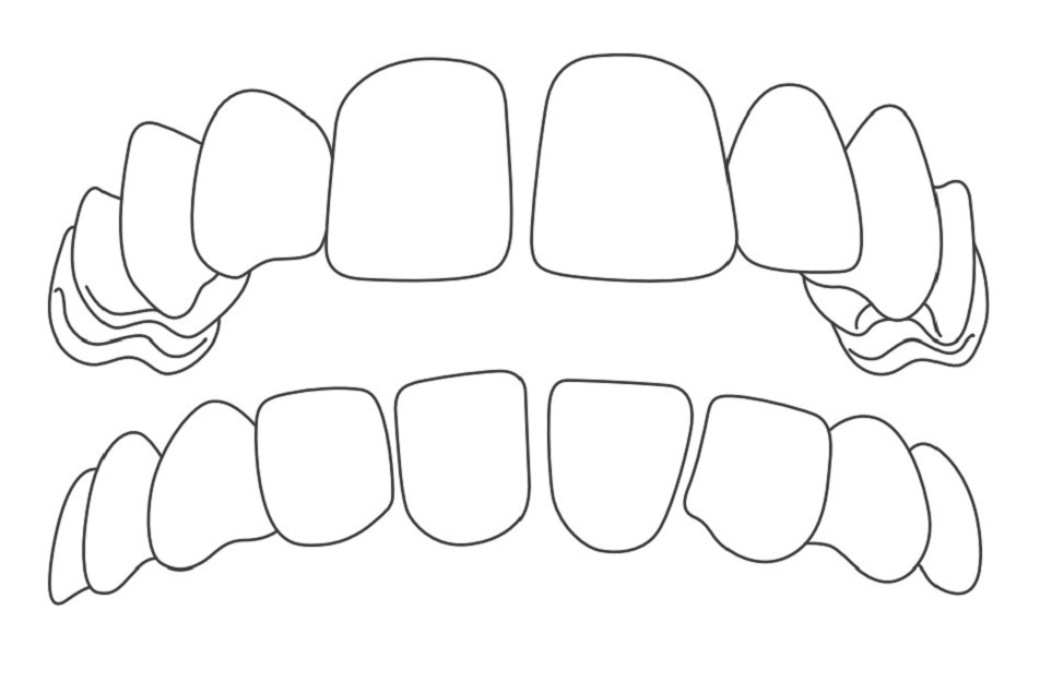 空隙歯列（すきっ歯）